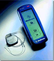 gastric pacing IGS